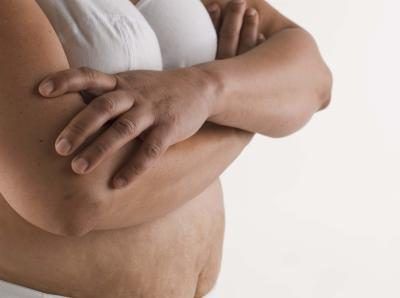 La perte de poids ou la grossesse peuvent provoquer le relâchement cutané et la cellulite.